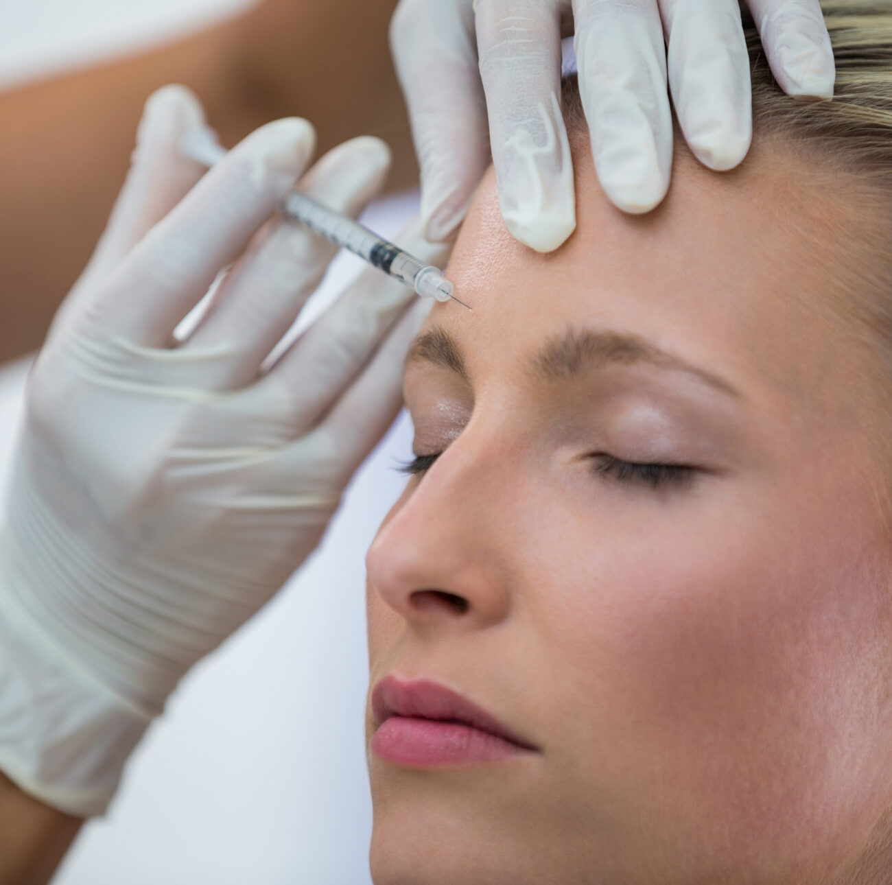 Example: Before and after dermal fillers in Calgary