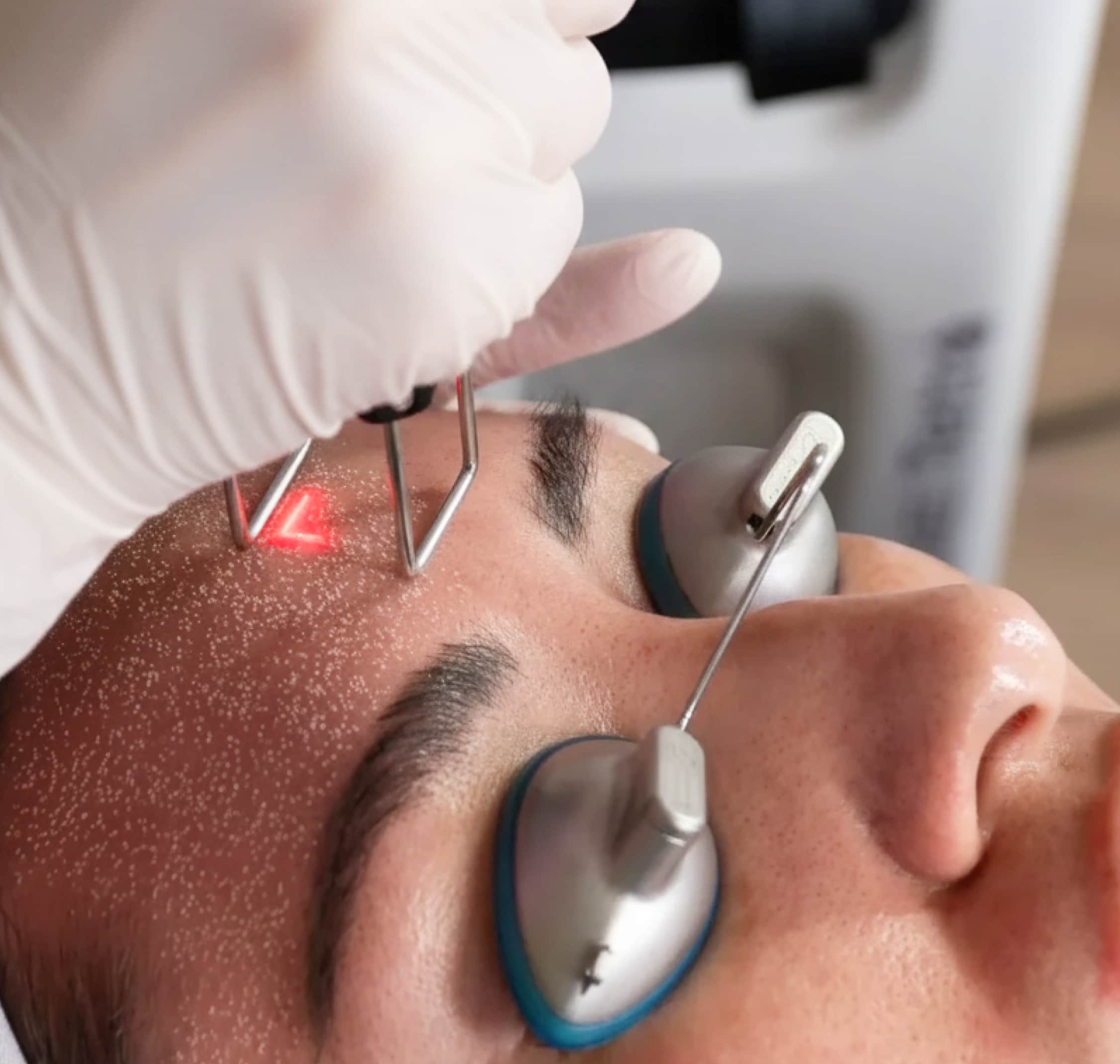 Example: Before and after dermal fillers in Calgary