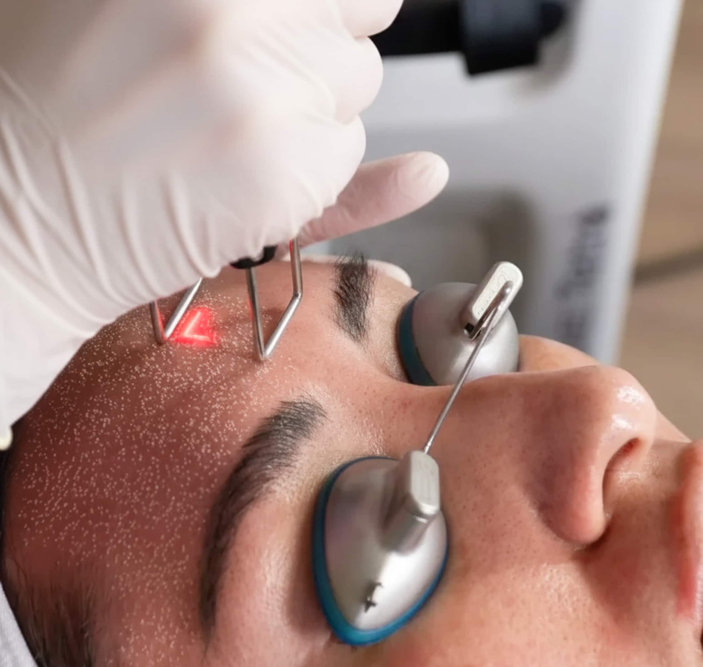 CoolPeel Treatment at SkinCrew Clinic Boca