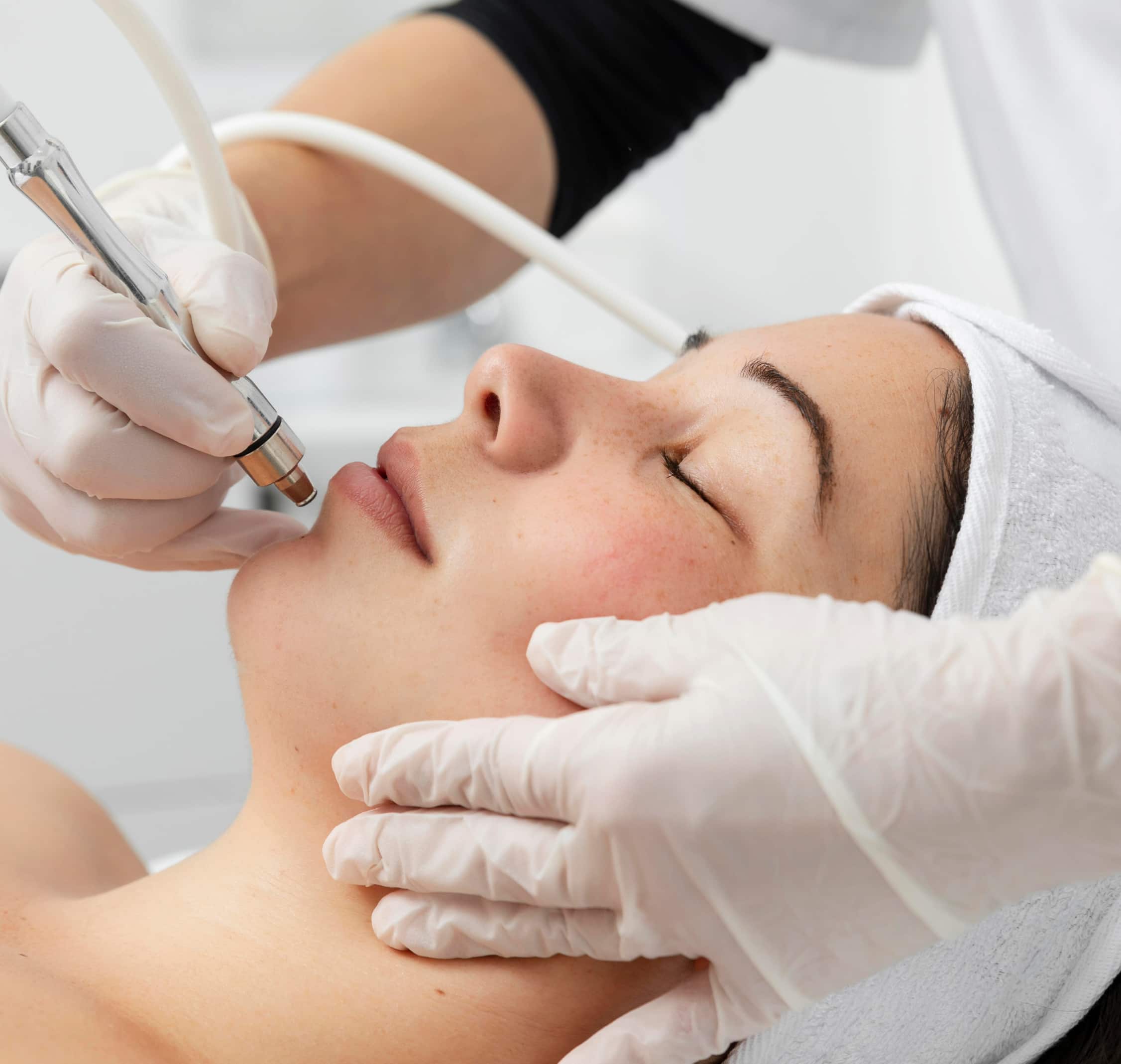 Example: Before and after dermal fillers in Calgary