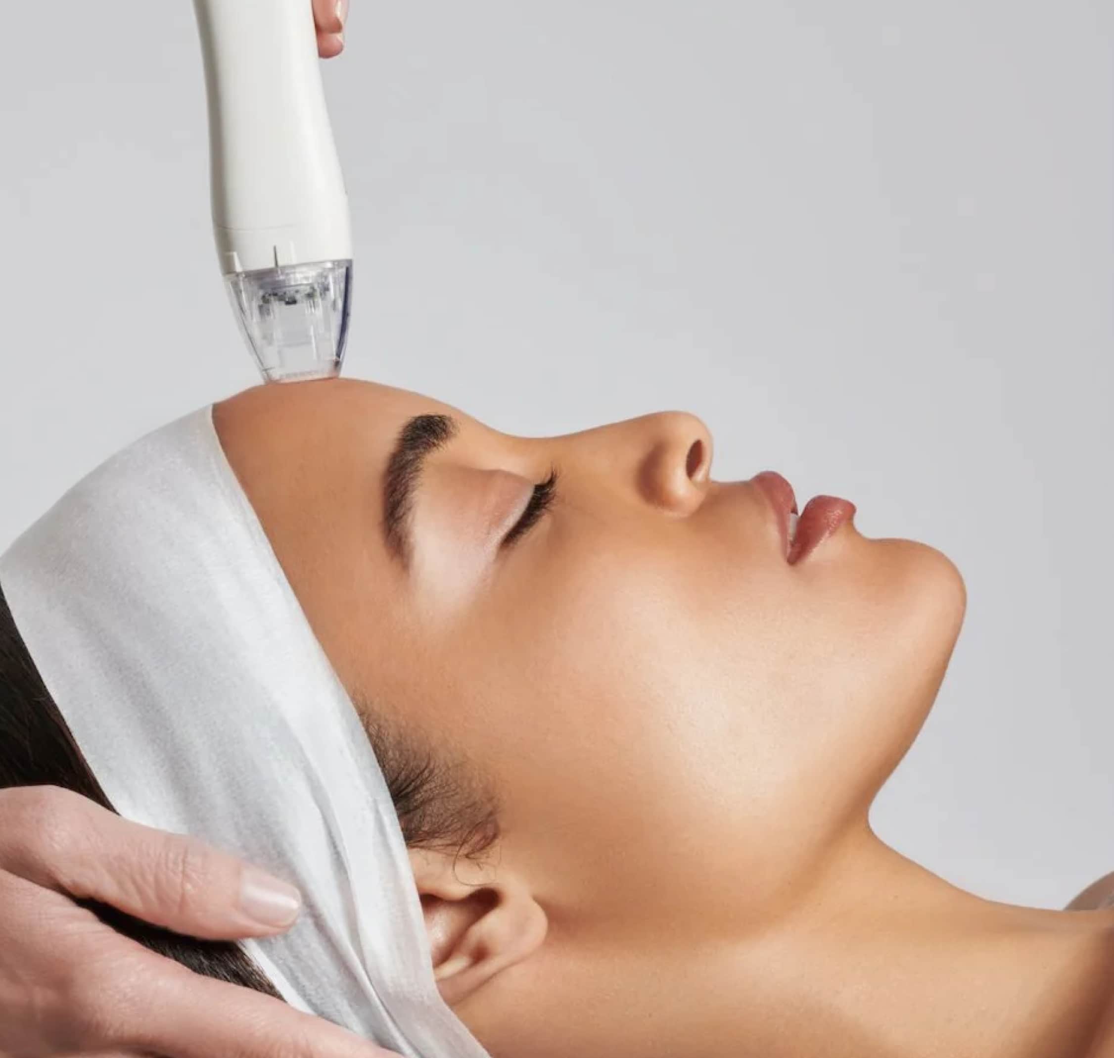 Virtue Microneedling Treatment at SkinCrew Clinic Boca